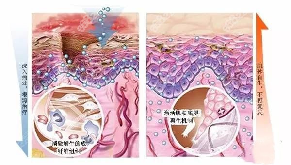 北京国丹皮肤病医院祛疤的方法