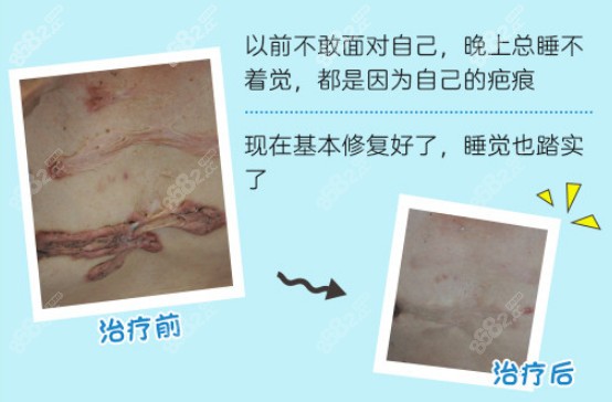北京国丹皮肤病医院祛疤对比图
