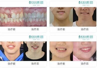 牙卫士牙科本院成功病例展示