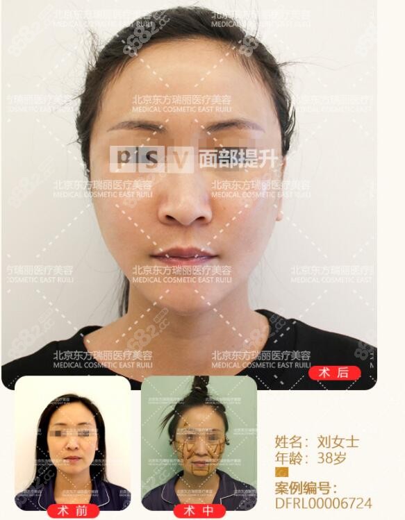 李曉東做pst面部提升術(shù)前術(shù)后對比圖