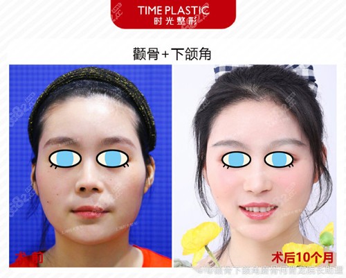 何晋龙下颌角手术效果图