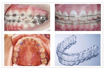 各种牙齿矫正方式对比