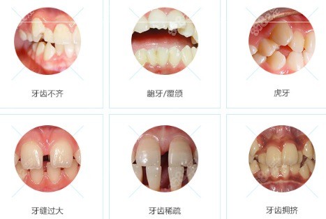 需要牙齿矫正的情况