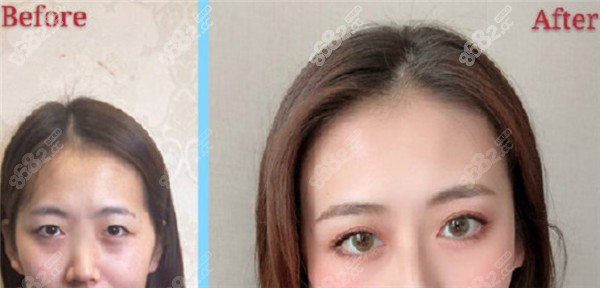 <!--<i data=20240705-sp></i>-->许炎龙双眼皮整形病例