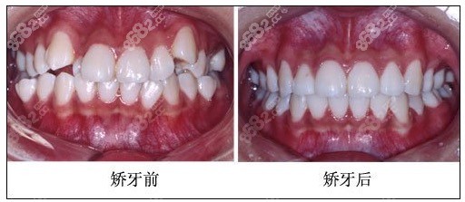 麦芽口腔牙齿矫正前后效果对比