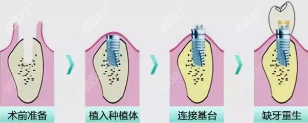 种植牙的步骤分哪些