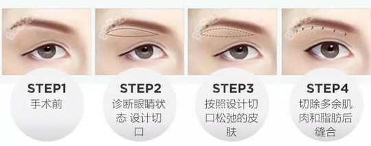 切开双眼皮手术图示