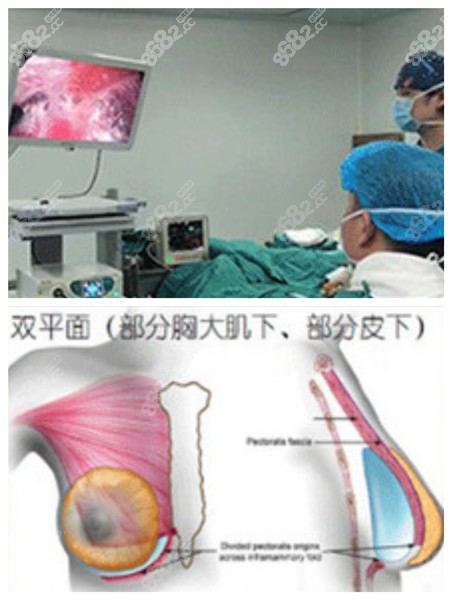 10分钟极速丰胸手术采用的内窥镜双平面技术
