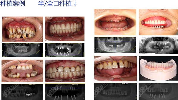 美奥口腔多颗牙/半口/全口牙缺失种植牙图片