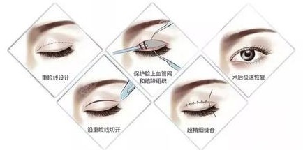 医生做的双眼皮修复手术用的纳米血管保留术