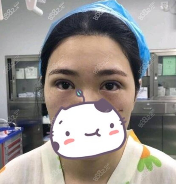 双眼皮修复前是宽双眼皮