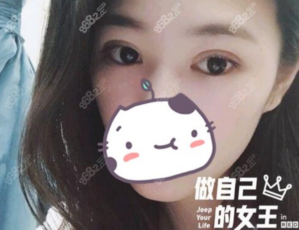 医生做双眼皮失败修复效果图