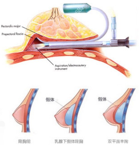 假体隆胸的过程图片