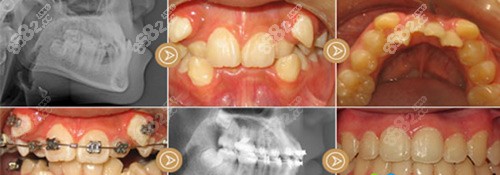 东莞好佰年口腔门诊牙齿矫正示意图