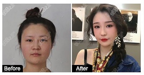 上海美联臣医疗美容医院金振珸院长下颌角整形术后效果