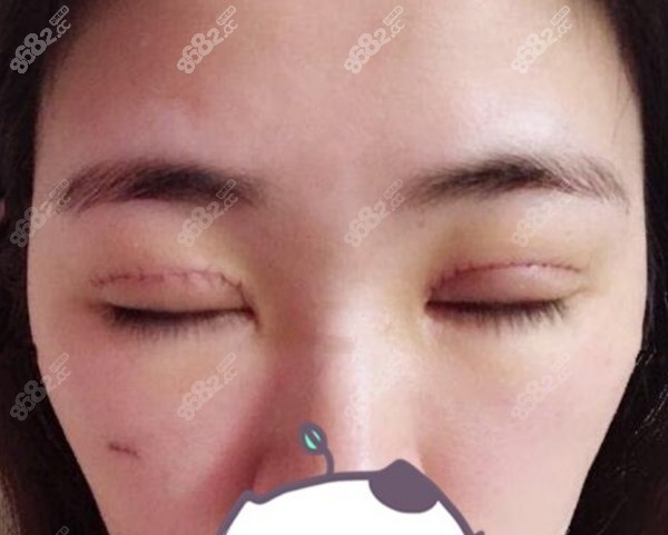 上海医生刚做眼修复的样子