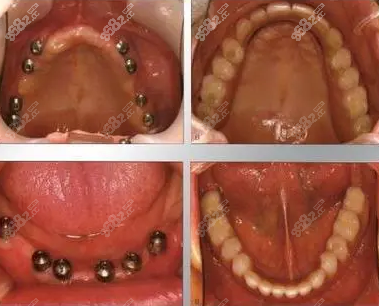 北京劲松口腔医院全口种植牙效果