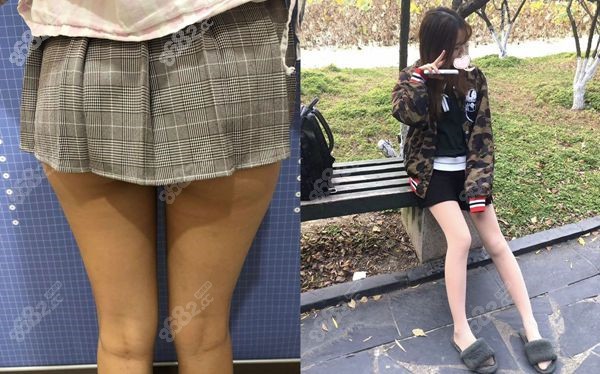 <!--<i data=20240705-sp></i>-->张让虎做大腿吸脂的效果图.jpg