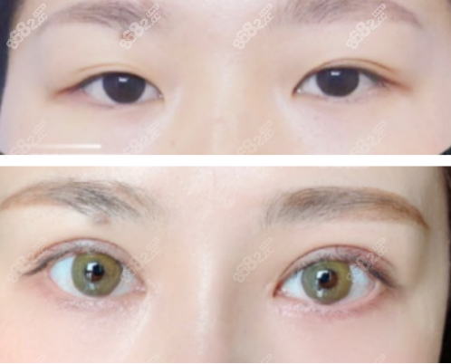 <!--<i data=20240705-sp></i>-->医生做的双眼皮效果图一