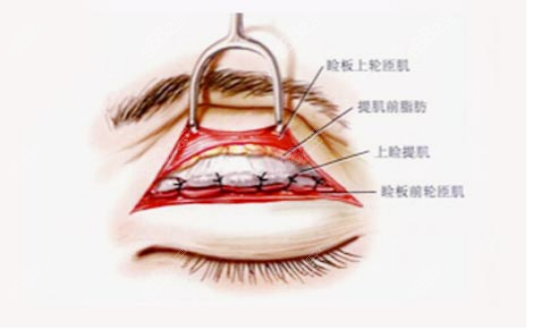 <!--<i data=20240705-sp></i>-->医生做双眼皮的动画图