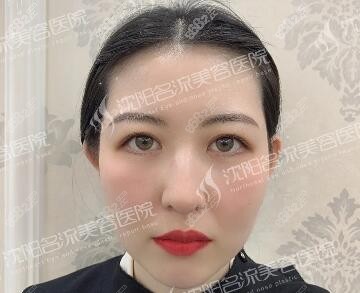沈阳名流做眼综合30天恢复照