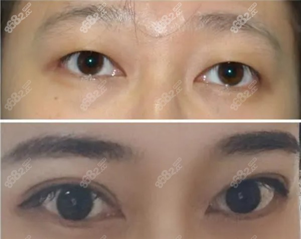 何祥龙扇形双眼皮效果