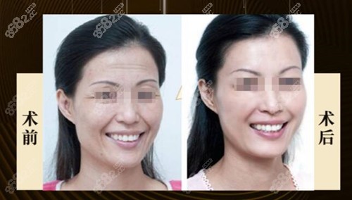 黃廣香面部提升效果圖 黃廣香面部提升效果圖