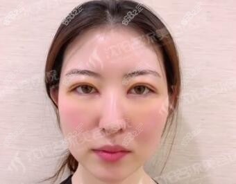 做眼综合术后7天照