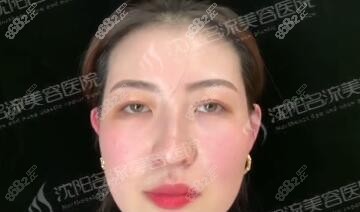 沈阳名流做眼综合术后即刻效果照