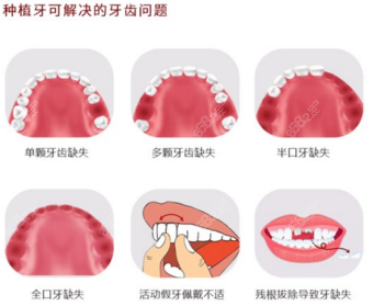 种植牙可以解决的问题