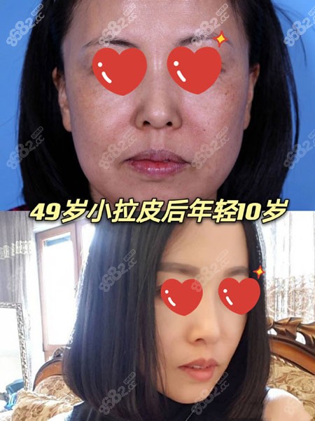 49歲去北京加減美做V6拉皮術(shù)后效果 49歲去北京加減美做V6拉皮術(shù)后效果