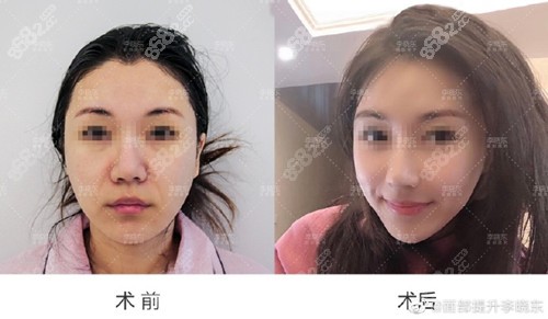李曉東面部提升效果圖 李曉東面部提升效果圖