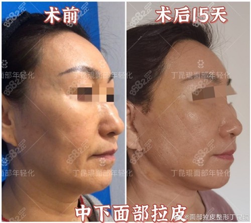 丁昆琨面部提升效果對比圖 丁昆琨面部提升效果對比圖
