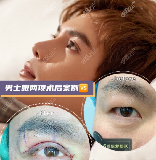 <!--<i data=20240705-sp></i>-->医生做的双眼皮效果图二