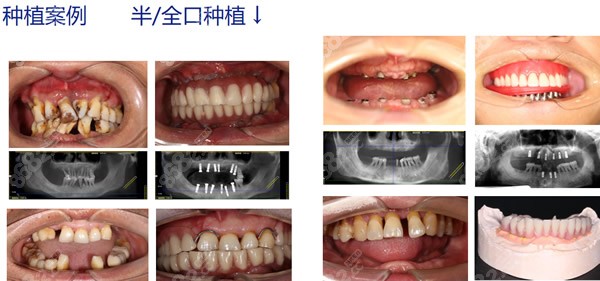 美奥口腔半口/全口种植牙对比照片