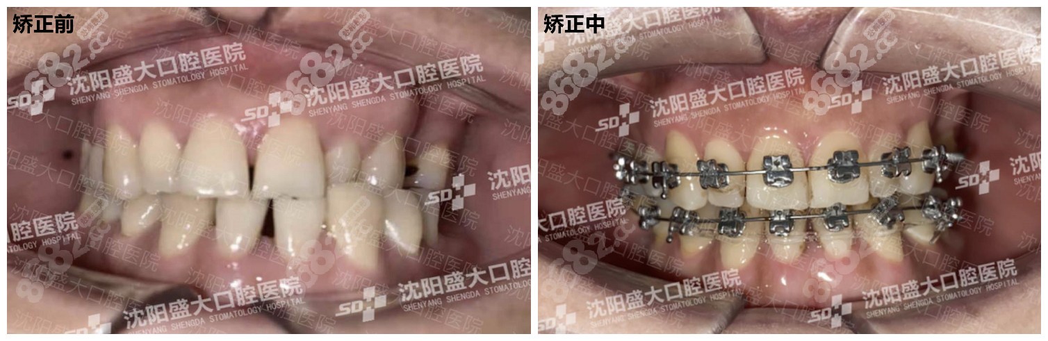 矫正前后对比