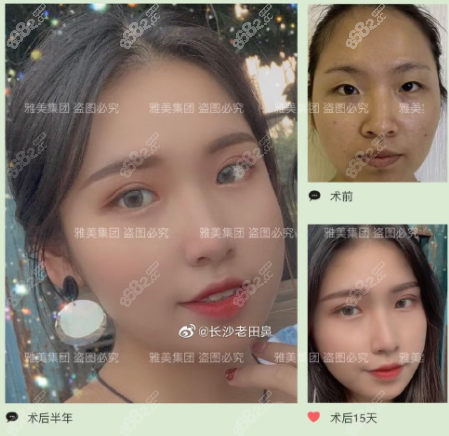 田芳斌做眼综合的对比照