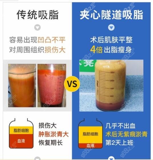 夹心隧道吸脂和传统吸脂的区别