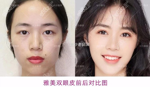 长沙雅美双眼皮前后对比图