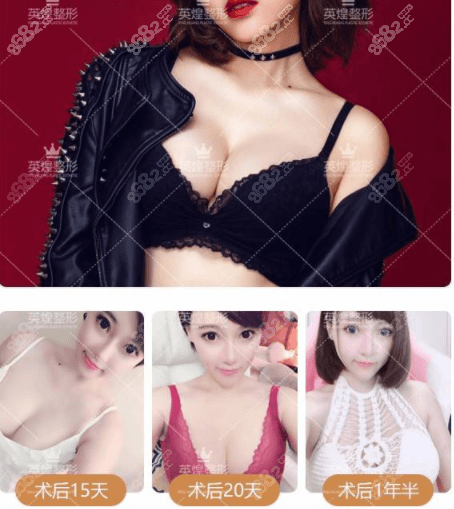 项力源给我做的脂肪丰胸效果自然