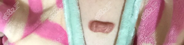 上海九院高振医生手术切除胸前原发性疤痕疙瘩的图片来啦