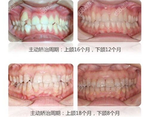 石家庄美年美华口腔牙齿矫正前后图