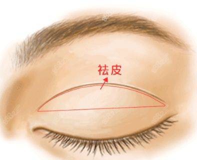 冯显雅医生做双眼皮宽变窄的过程