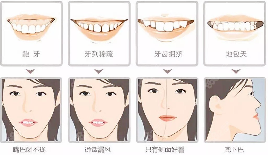 需要牙齿矫正的几种类型