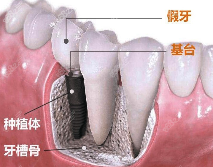 苏州种植牙医院排名