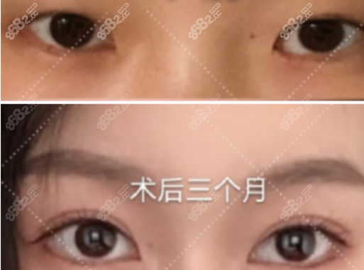 <!--<i data=20240705-sp></i>-->做双眼皮的效果图2