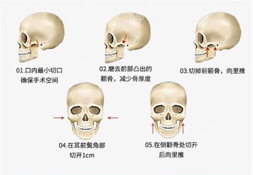 赵绛波颧骨内推原理