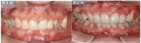 北京斯迈尔口腔正畸医生吴彬彬牙齿矫正效果