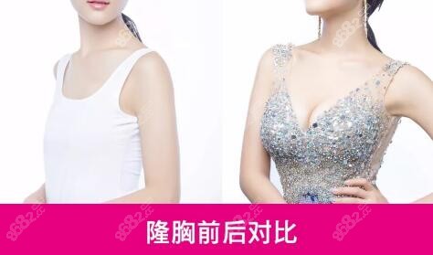 衡阳雅美假体隆胸真人前后对比照