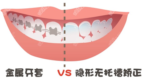 金属托槽牙套和隐形牙套对比图